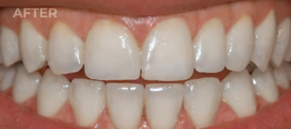 An UpWhiten client's teeth before and after one session — result 6 of 6